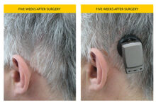 Photo of What are Cochlear Implant and Hearing Aids?
