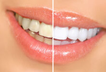 Photo of Let’s Talk About Some Amazing Benefits of Crest Whitening Strips UK