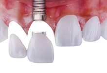 Photo of A Verbal Implant Supported Bridge For Changing A Row Of Missing Teeth
