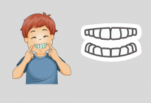 Photo of Invisalign Aligners