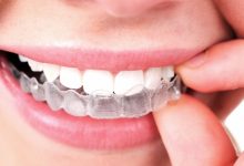 Photo of How Invisalign can Fix Unwanted Gaps from your Missing Teeth