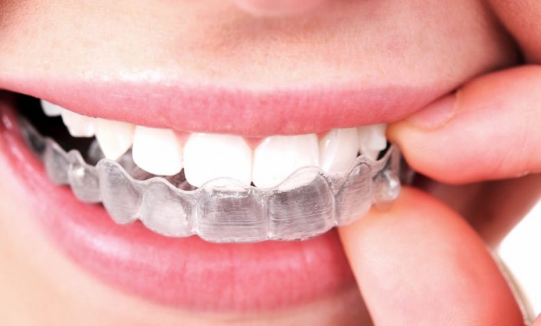 Invisalign for Gapped Teeth