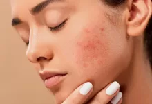 Photo of Acne Tips, Tricks, And Techniques For Flawless Skin