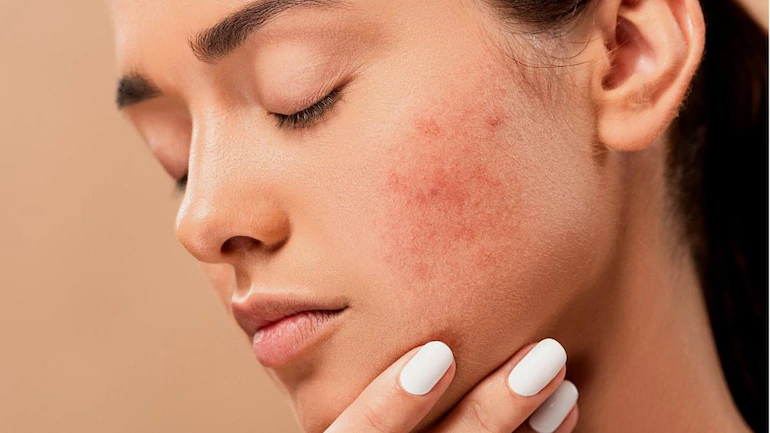 Photo of Acne Tips, Tricks, And Techniques For Flawless Skin