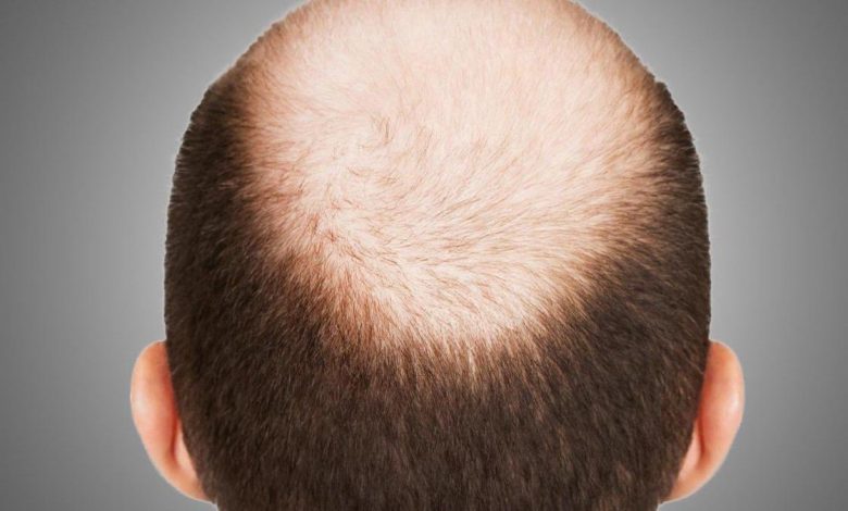 Photo of Male pattern baldness: What you need to know