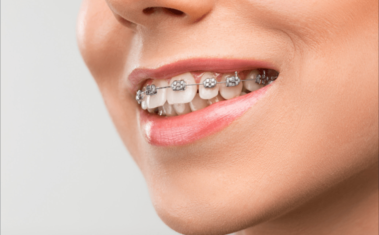 Photo of Understand Why Invisalign Is The Best Choice To Straighten Teeth