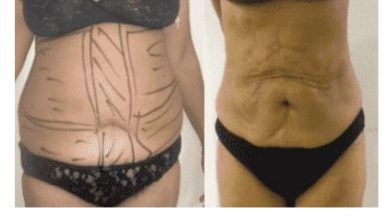 Photo of Key Facts of VASER Liposuction