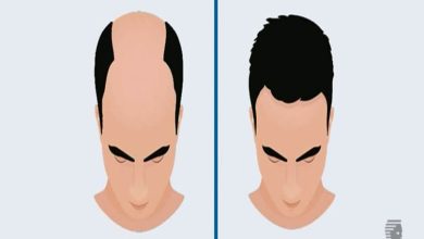 Photo of Hair Transplant in Karachi | Best Hair Transplant in Pakistan