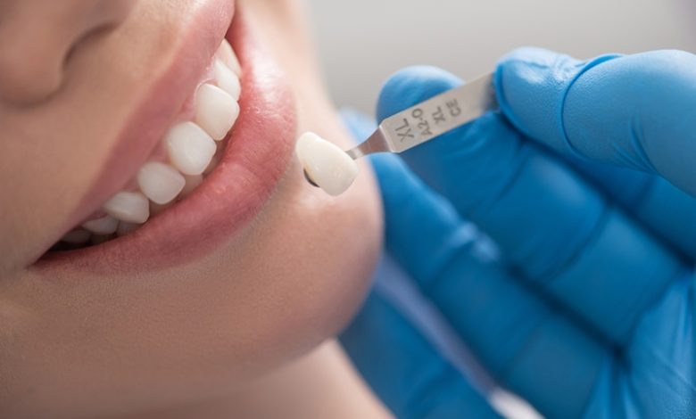 Dental Crowns: How To Use It And 5 Tips For Your Dental Crowns