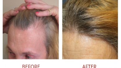 Photo of MTF and FTM Transgender Hair Transplant for hair loss