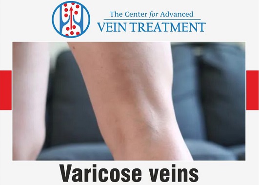 Photo of WHAT ARE 5 TIPS FOR FINDING A GOOD VEIN SPECIALIST?