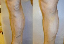 Photo of How Does Varicose Veins Treatment Work?