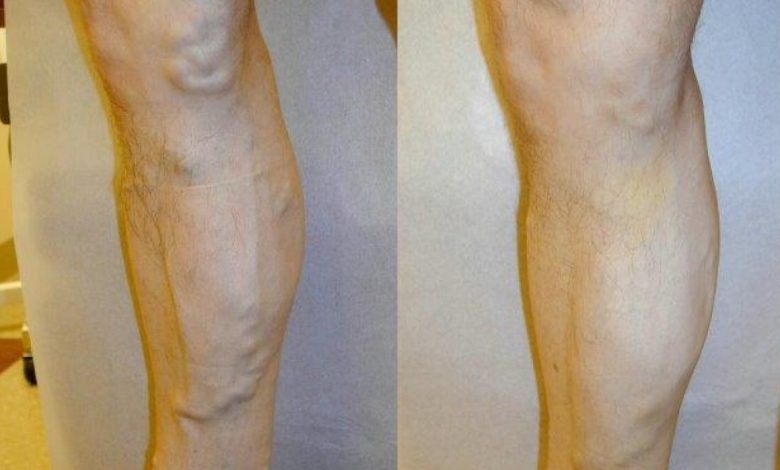 Photo of How Does Varicose Veins Treatment Work?