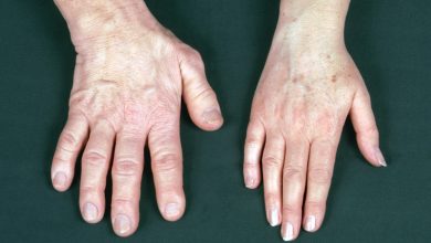 Photo of What is Acromegaly and which are the possible symptoms?