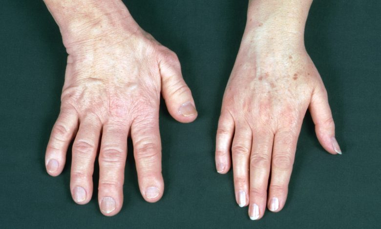 Photo of What is Acromegaly and which are the possible symptoms?