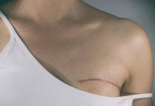 Photo of Breast Cancer and Its Symptoms