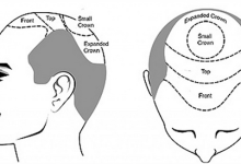 Photo of Why Should Consider Hair Transplantation Cost?