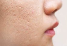 Photo of What to know about acne face maps