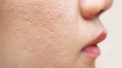 Photo of What to know about acne face maps