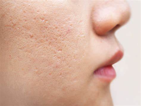 Photo of What to know about acne face maps