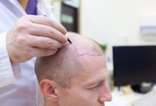 Photo of 5 Services That Hair Restoration Clinic Provides