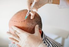 Photo of Follicular Unit, FUE Hair Transplant: Hair Fall Clinic