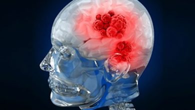 Photo of What is the stage 3 brain cancer survival rate?