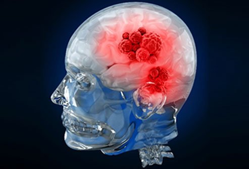 stage 3 brain cancer survival rate