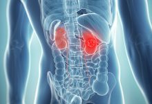 Photo of What are the Kidney Tumor Treatments?