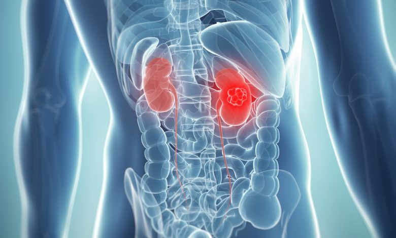 Kidney Tumor Treatments