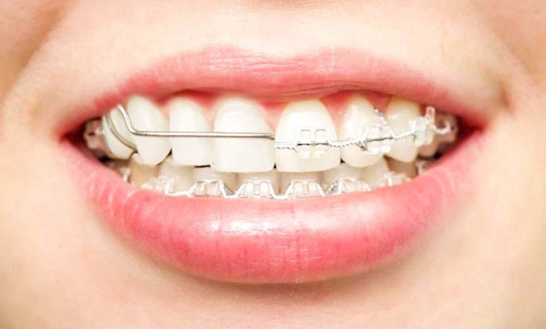 Photo of Why Does Your Dentist Want You to Wear a Teeth Retainer?