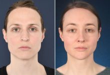 Photo of 5 Things You Need To Know About Hairline Lowering Surgery