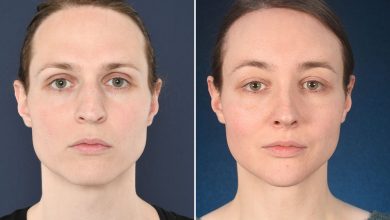 Photo of 5 Things You Need To Know About Hairline Lowering Surgery