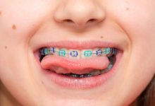 Photo of How much will cost of braces for kids?