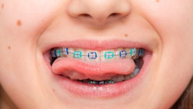 Photo of How much will cost of braces for kids?