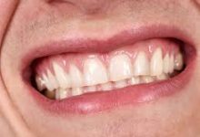 Photo of How Much Do Veneers Cost?