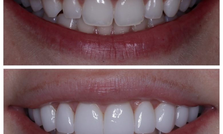 Photo of Veneers: Everything You Need to Know