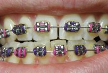 Photo of What Are Power Chains For Braces?