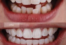 Photo of The Top Implant Dentists Near Me – Get the Best Smile Possible!