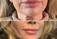 Photo of What Is Facelift Surgery (Rhytidectomy)?