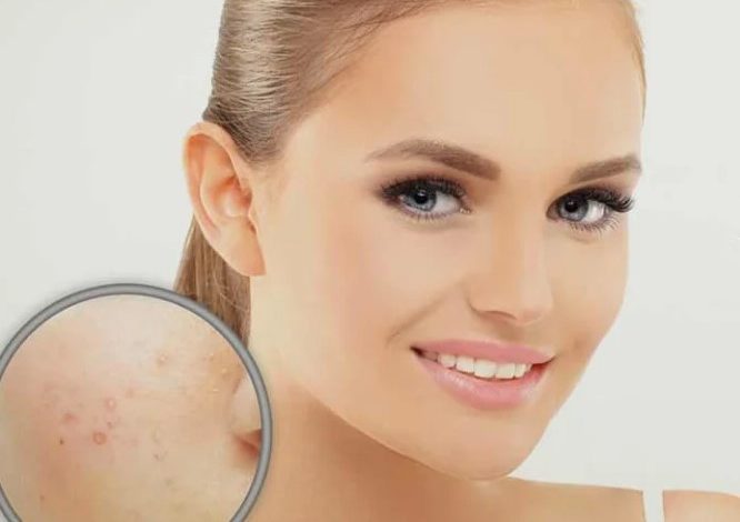 Photo of How to Get Rid of Acne Scars in a Short Time!