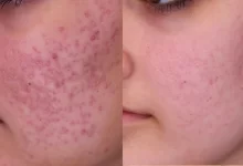 Photo of Unlocking the Secrets to Treating deep acne scars treatment