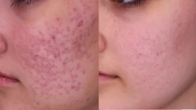 Photo of Unlocking the Secrets to Treating deep acne scars treatment
