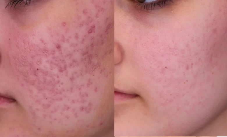 deep acne scars treatment